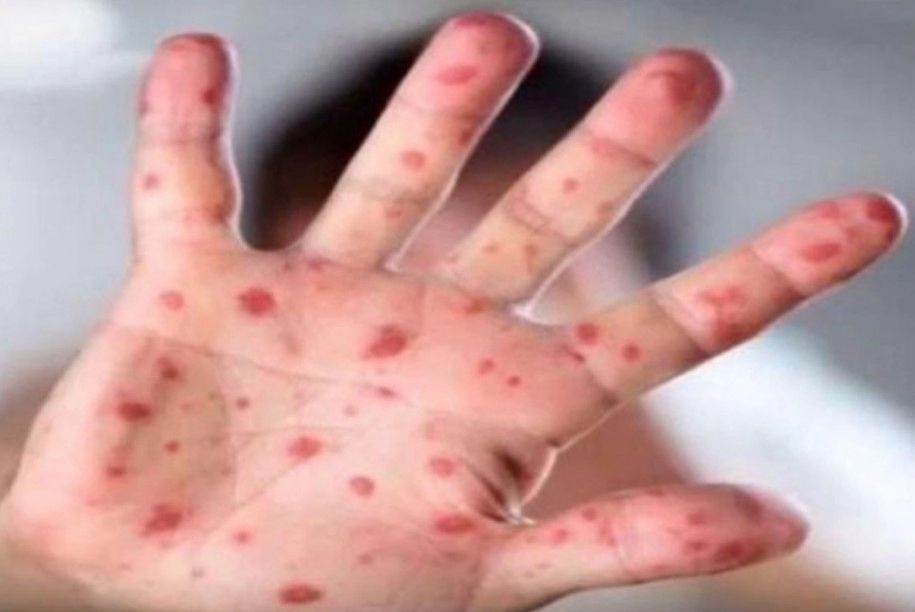 Bez novozaraženih od morbila, bliži se kraj epidemije u ZDK-u